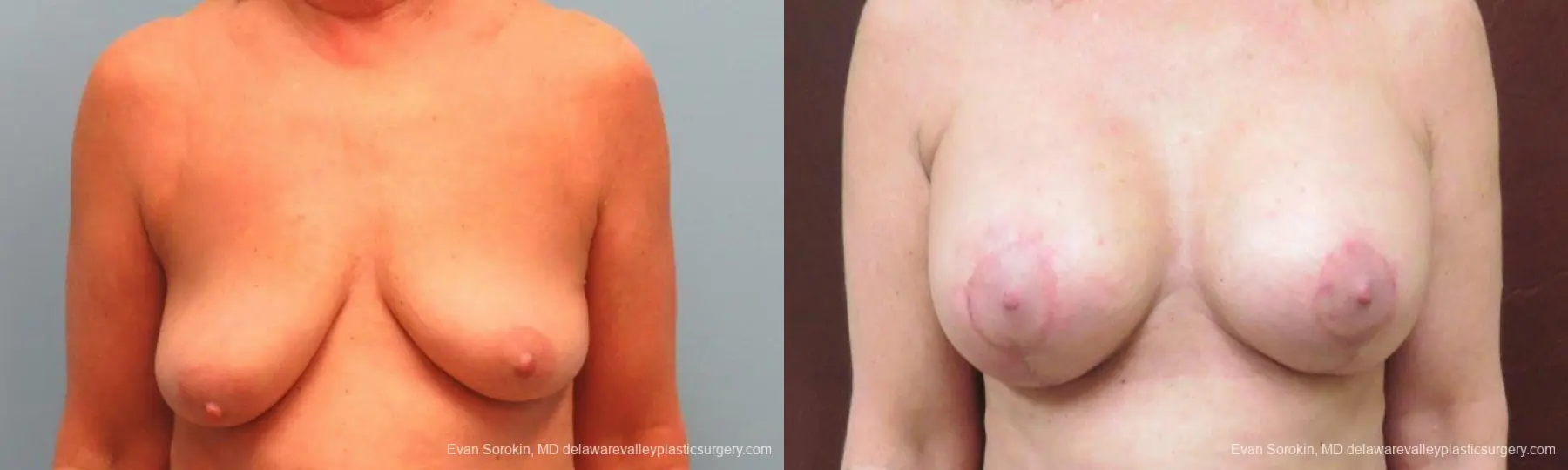 Philadelphia Breast Lift and Augmentation 9598 - Before and After