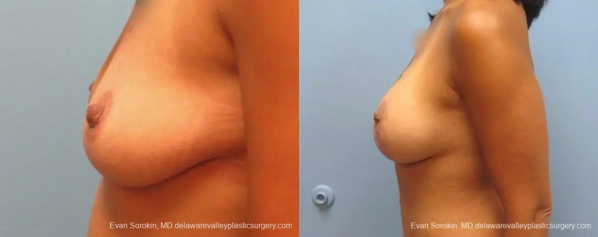 Philadelphia Breast Lift and Augmentation 8824 - Before and After 4