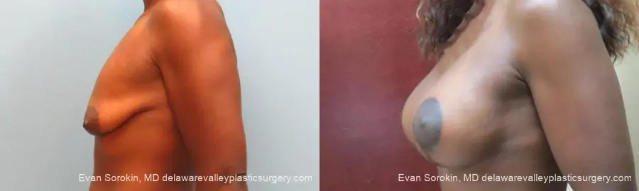 Philadelphia Breast Lift and Augmentation 10120 - Before and After 4