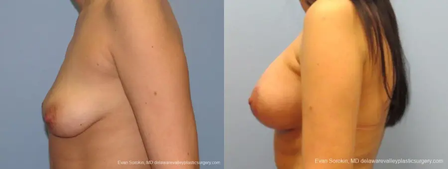 Philadelphia Breast Lift and Augmentation 10115 - Before and After 5