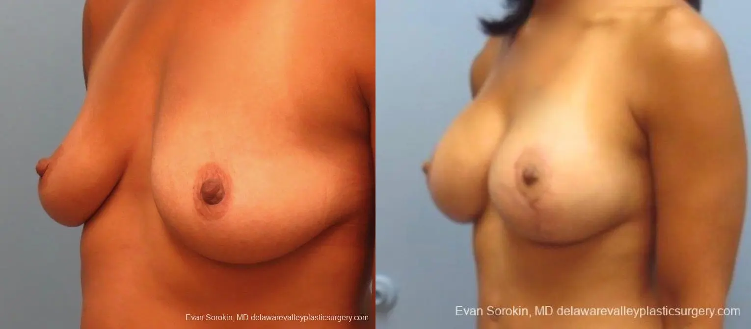 Philadelphia Breast Lift and Augmentation 8824 - Before and After 3