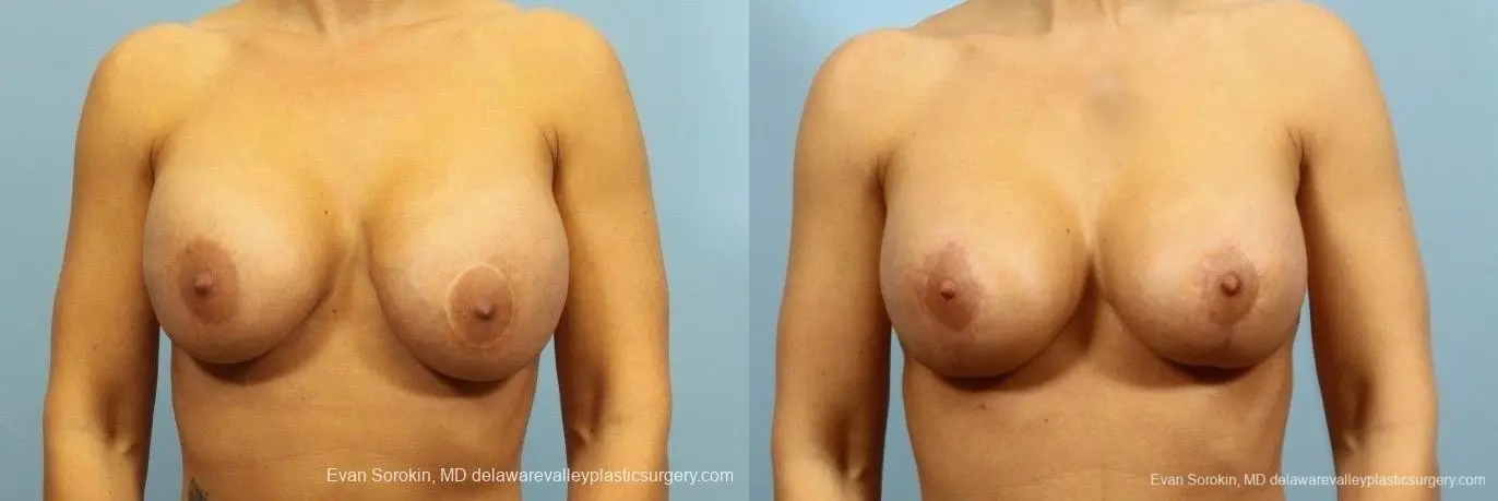 Philadelphia Breast Lift and Augmentation 8710 - Before and After 1