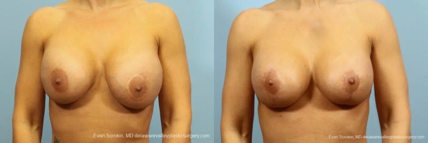 Philadelphia Breast Lift and Augmentation 8710 - Before and After