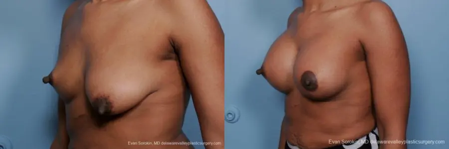 Philadelphia Breast Lift and Augmentation 8689 - Before and After 3