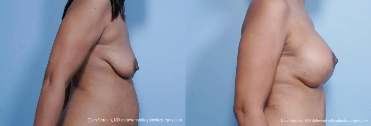 Philadelphia Breast Lift and Augmentation 8692 - Before and After 4
