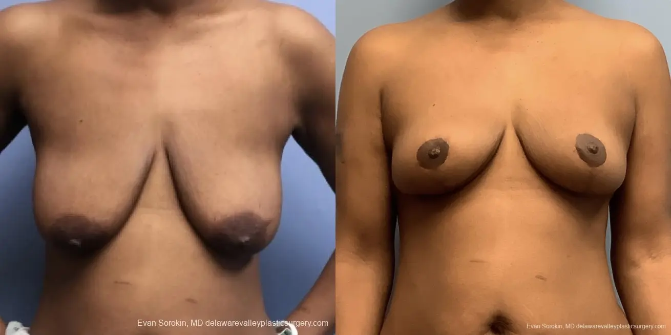 Breast Lift And Augmentation: Patient 45 - Before and After 1