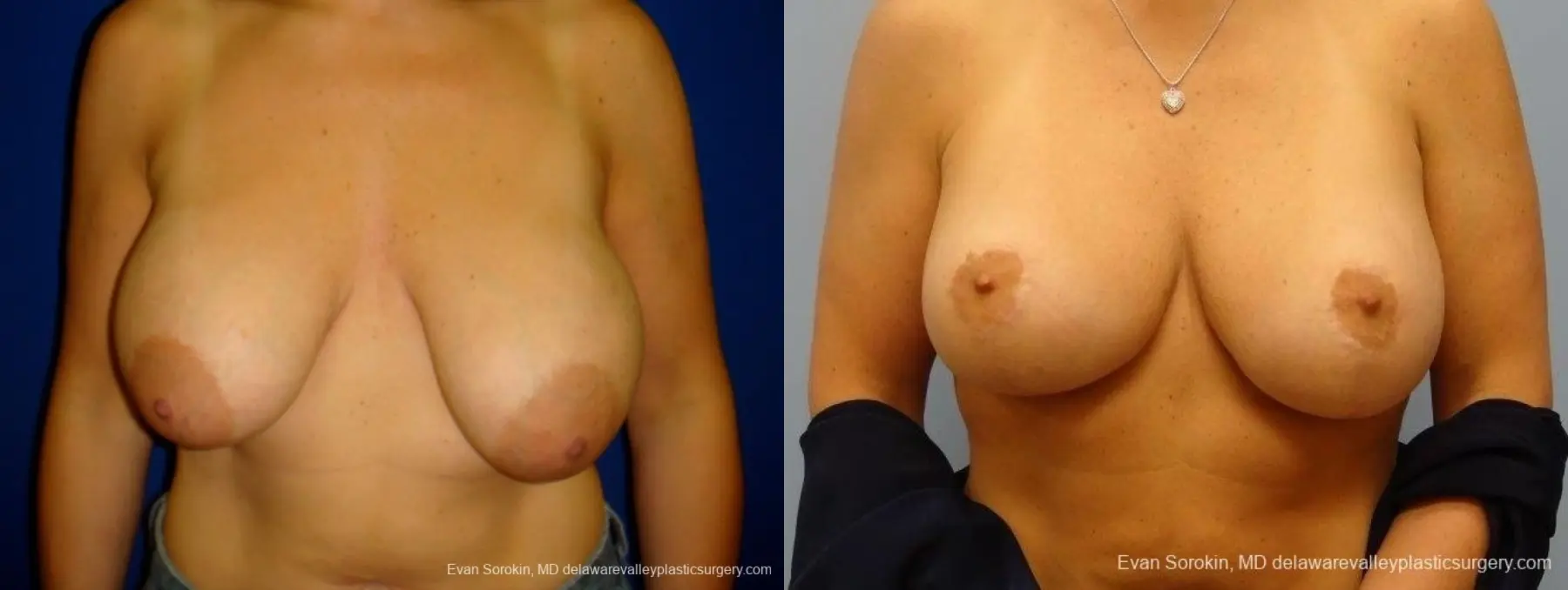 Philadelphia Breast Lift and Augmentation 8696 - Before and After 1