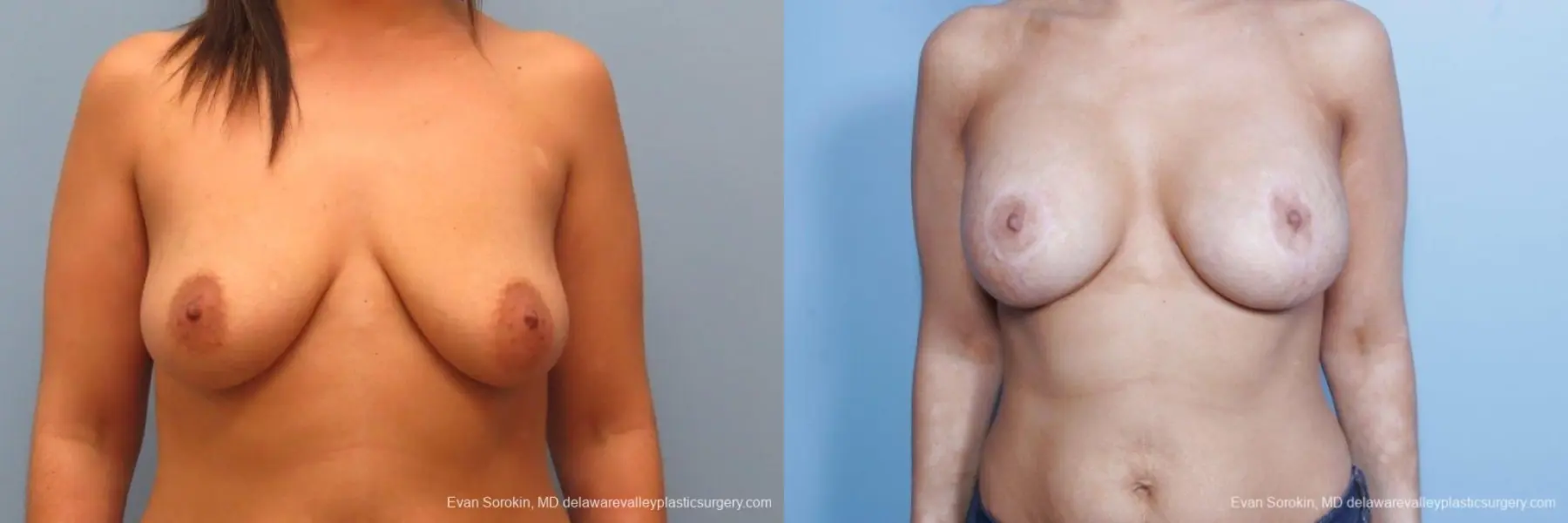 Philadelphia Breast Lift and Augmentation 8688 - Before and After 1