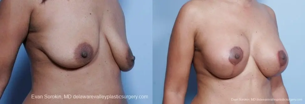 Philadelphia Breast Lift and Augmentation 8692 - Before and After 2