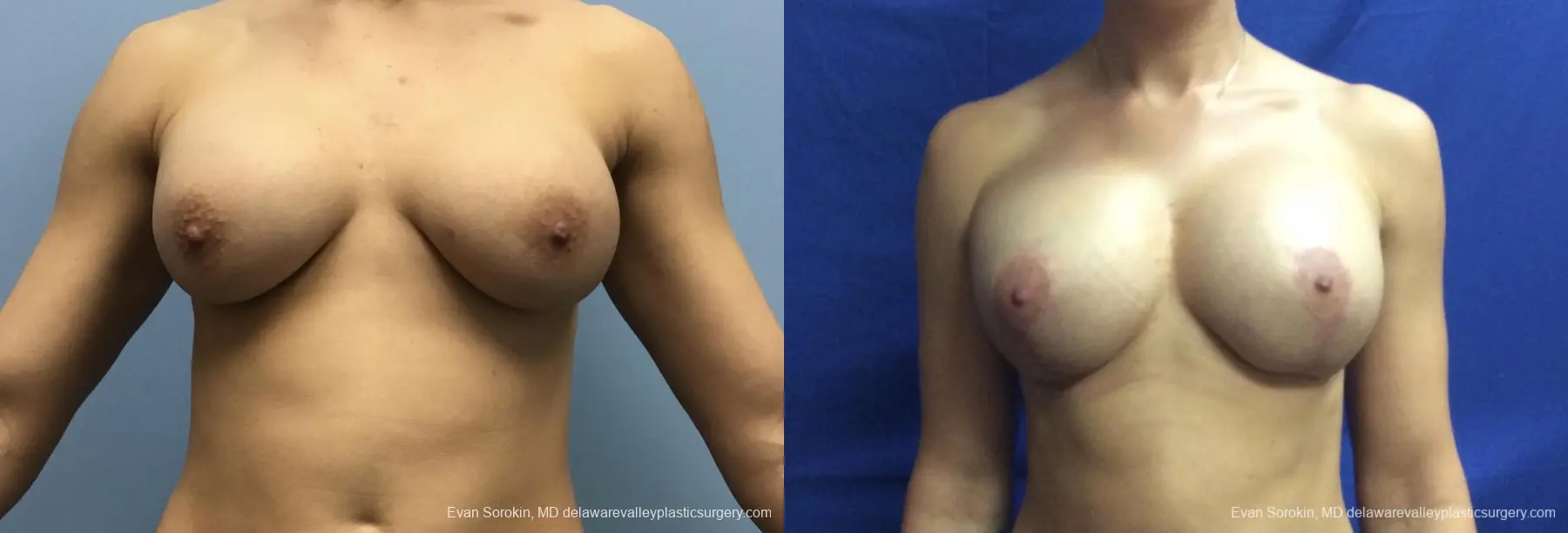 Breast Lift And Augmentation: Patient 42 - Before and After 1