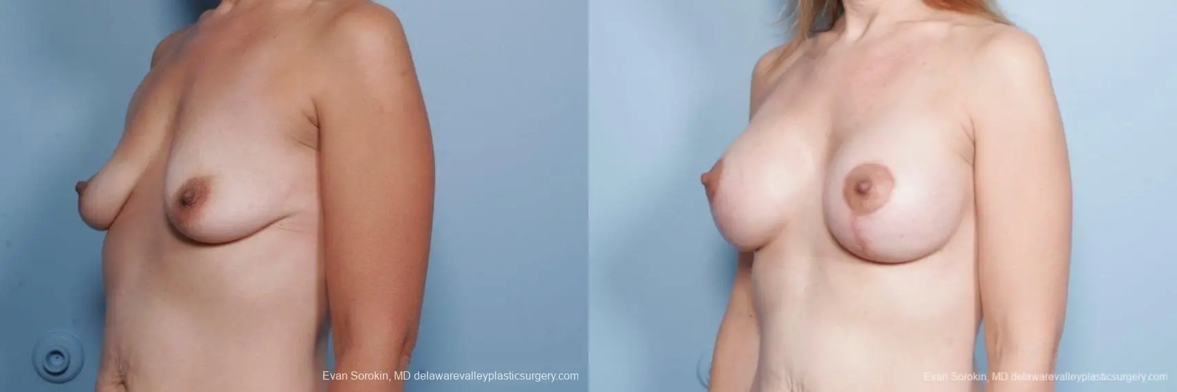 Philadelphia Breast Lift and Augmentation 8685 - Before and After 3