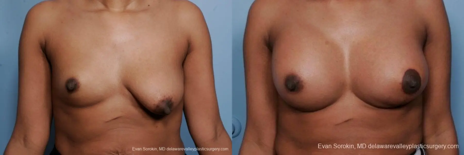Philadelphia Breast Lift and Augmentation 8689 - Before and After 1