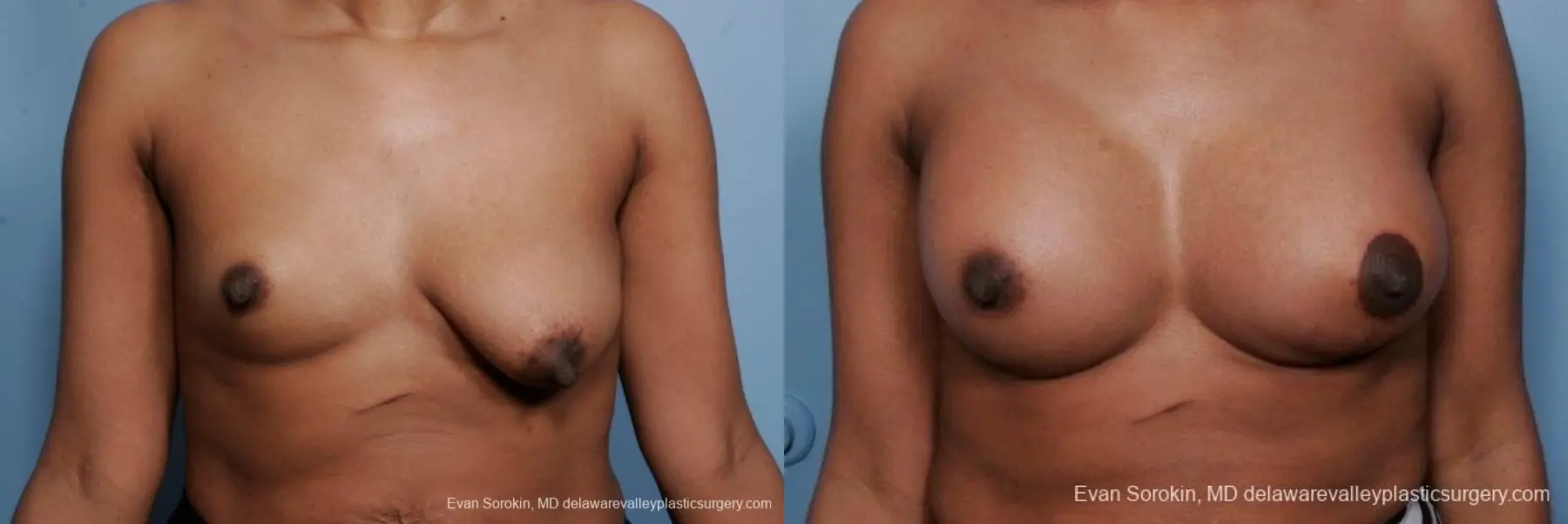 Philadelphia Breast Lift and Augmentation 8689 - Before and After