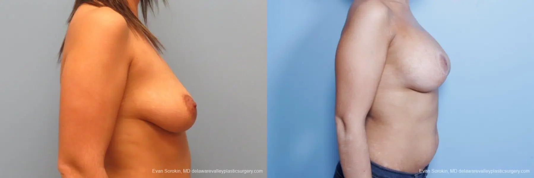 Philadelphia Breast Lift and Augmentation 8688 - Before and After 4