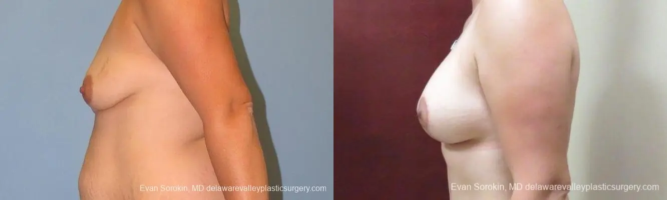Philadelphia Breast Lift and Augmentation 10123 - Before and After 5