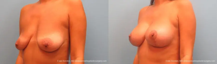 Philadelphia Breast Lift and Augmentation 10247 - Before and After 4