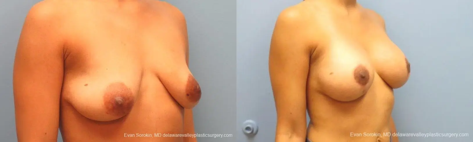 Philadelphia Breast Lift and Augmentation 10119 - Before and After 2