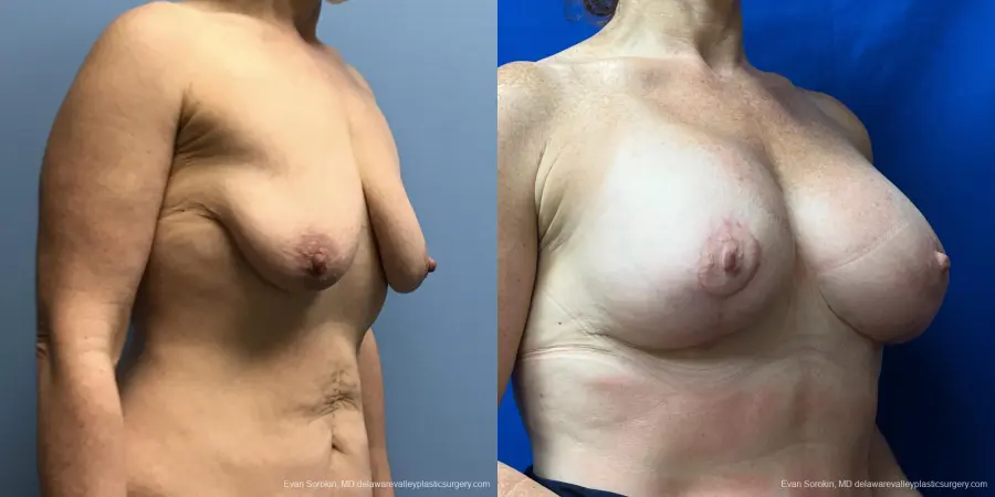 Breast Lift And Augmentation: Patient 47 - Before and After 2