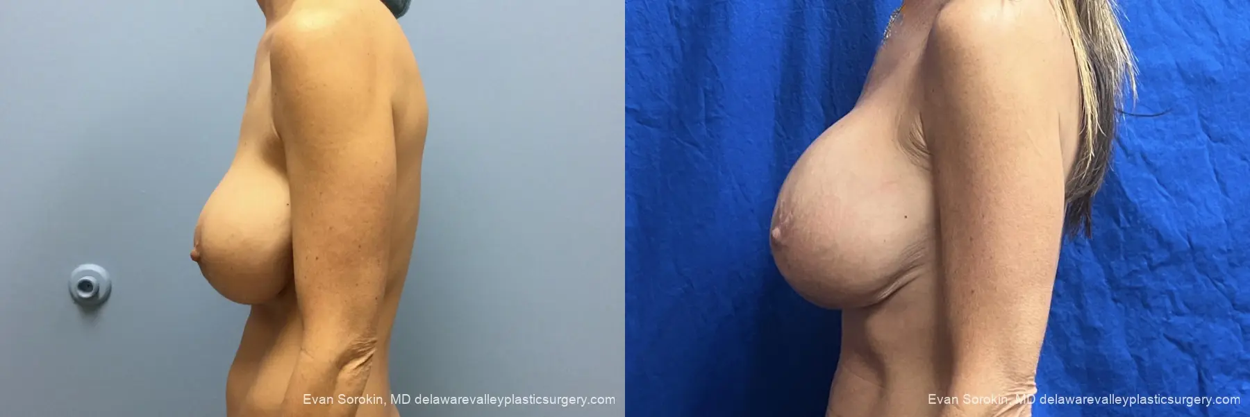 Breast Lift And Augmentation: Patient 58 - Before and After 5