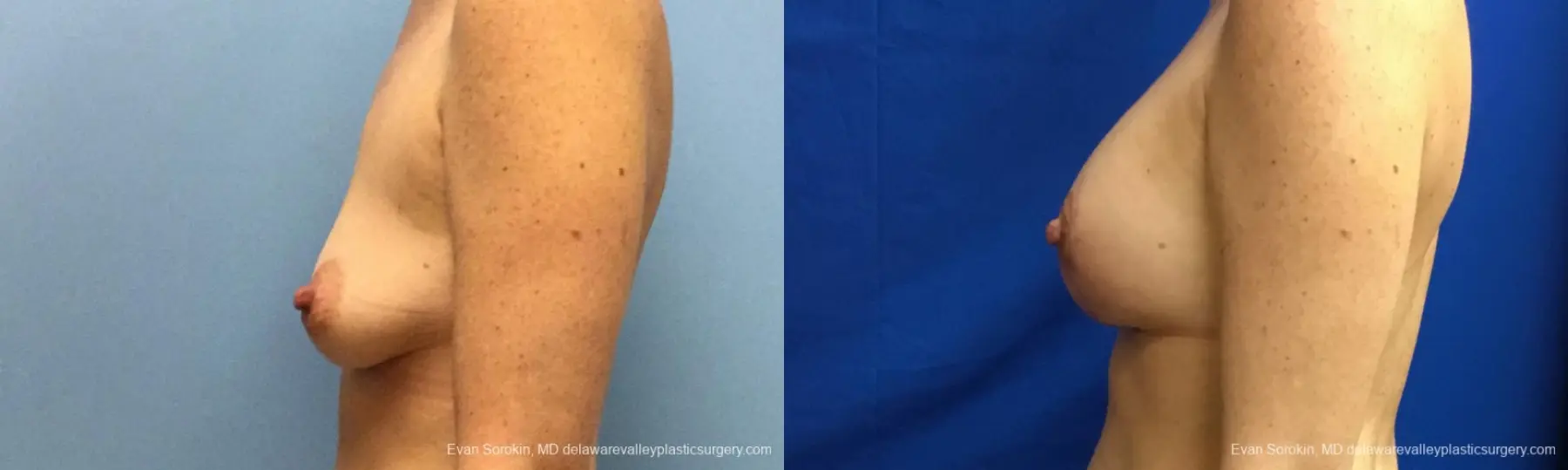 Philadelphia Breast Lift and Augmentation 10814 - Before and After 5