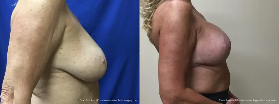 Breast Lift And Augmentation: Patient 49 - Before and After 3