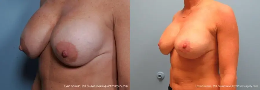 Philadelphia Breast Lift and Augmentation 8690 - Before and After 3
