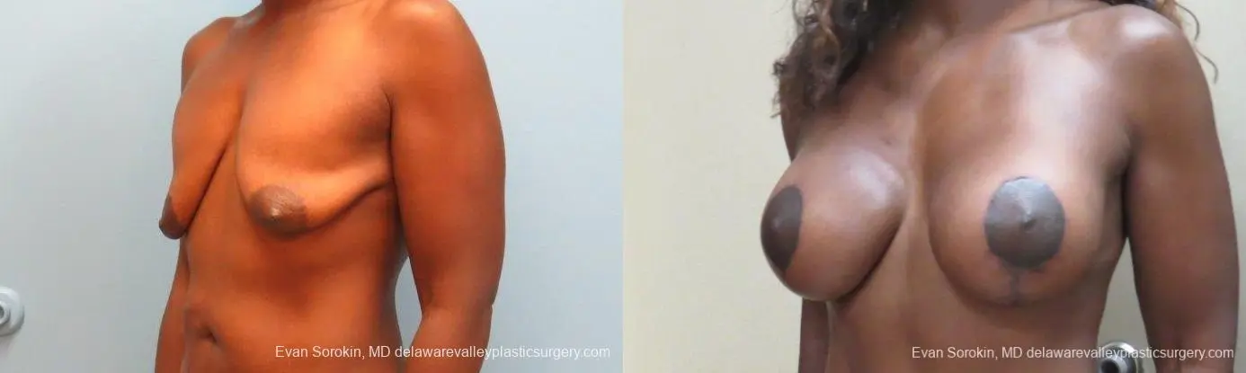 Philadelphia Breast Lift and Augmentation 10120 - Before and After 3