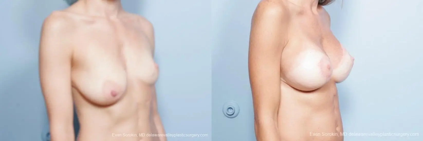 Philadelphia Breast Lift and Augmentation 8694 - Before and After 2