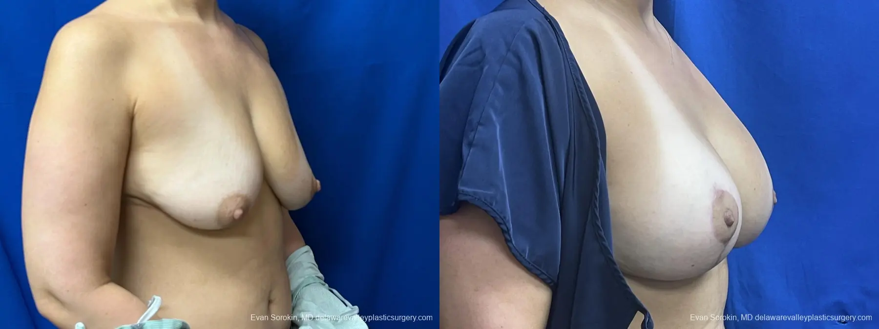 Breast Lift And Augmentation: Patient 51 - Before and After 2