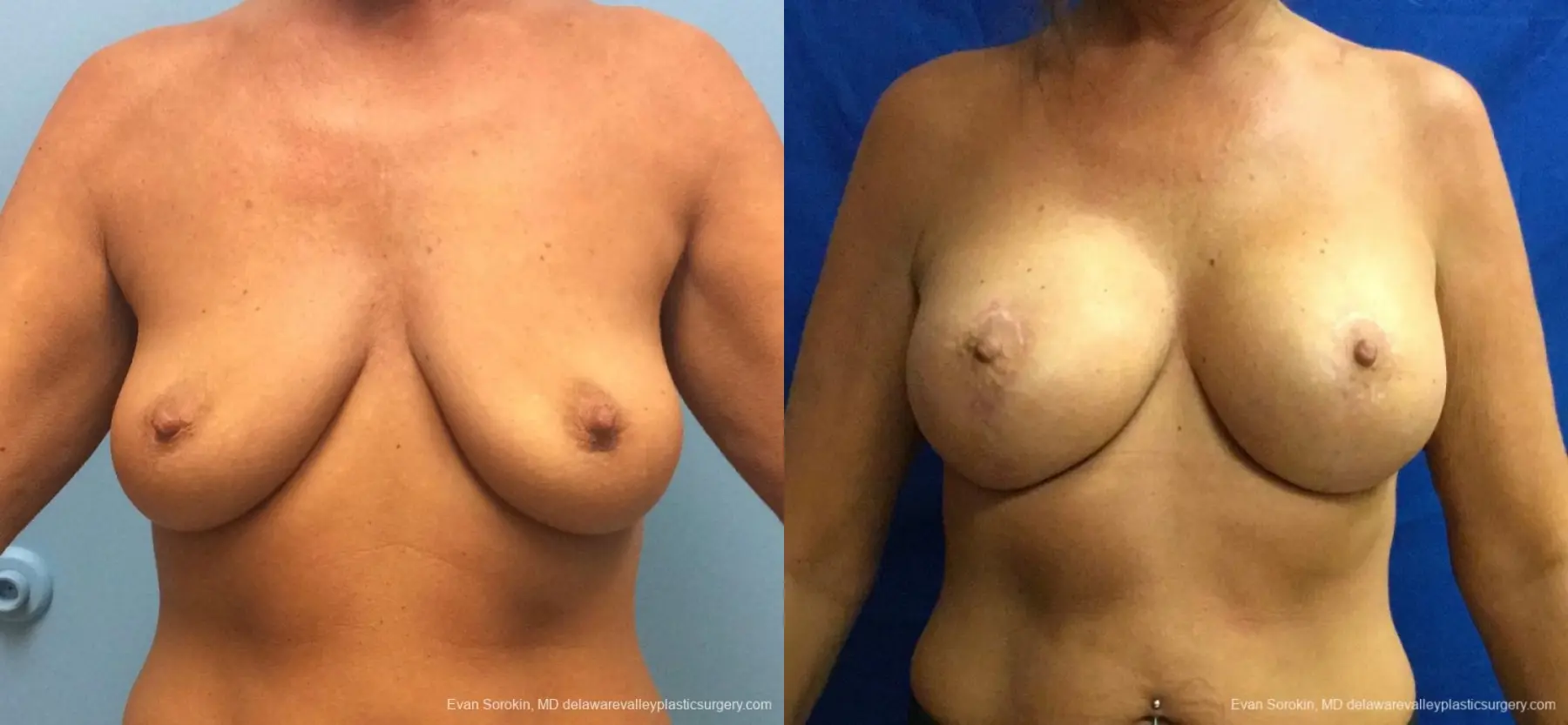 Philadelphia Breast Lift and Augmentation 13068 - Before and After 1