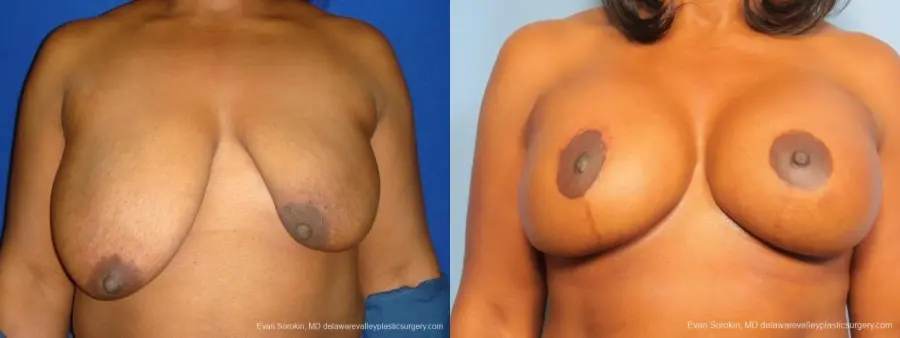 Philadelphia Breast Lift and Augmentation 8684 - Before and After 1