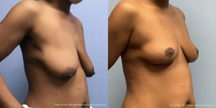 Breast Lift And Augmentation: Patient 45 - Before and After 3