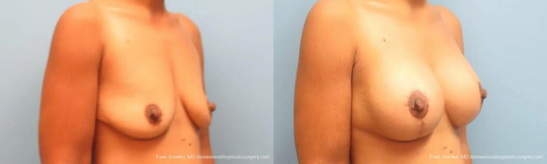 Philadelphia Breast Lift and Augmentation 9343 - Before and After 2