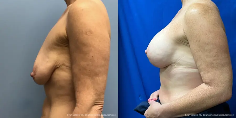 Breast Lift And Augmentation: Patient 47 - Before and After 5