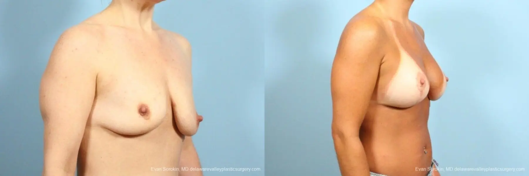 Philadelphia Breast Lift and Augmentation 8687 - Before and After 2