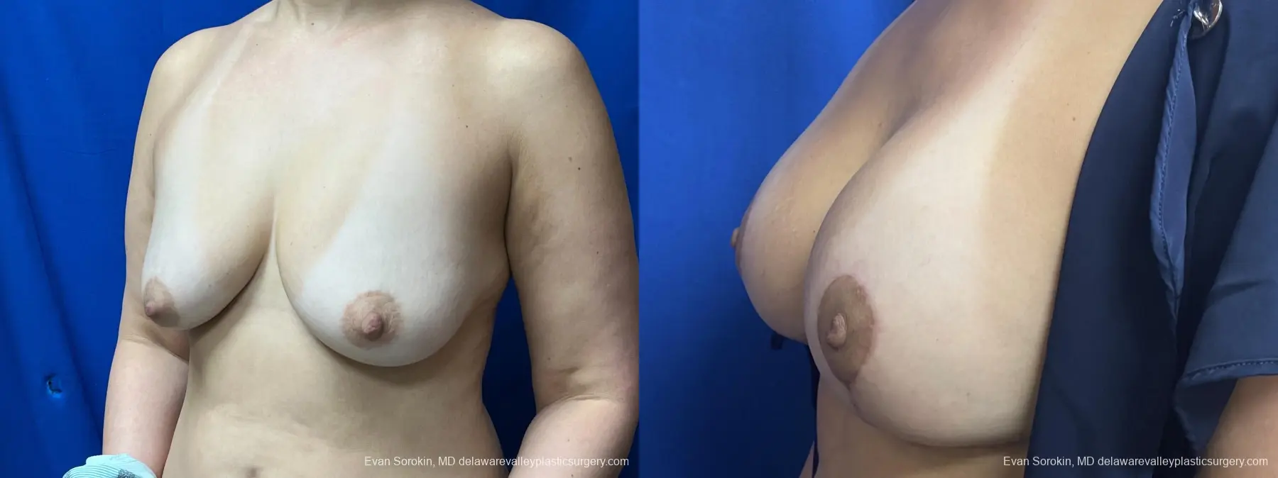 Breast Lift And Augmentation: Patient 51 - Before and After 3