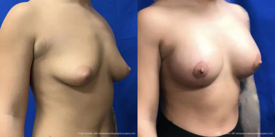 Breast Lift And Augmentation: Patient 43 - Before and After 2