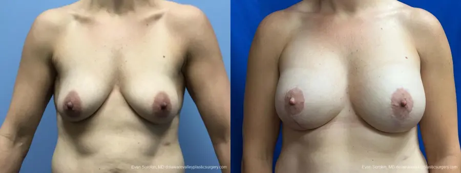 Breast Lift And Augmentation: Patient 48 - Before and After 1