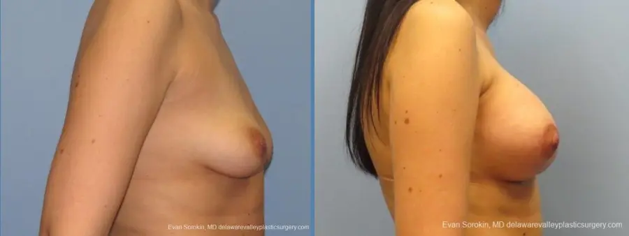 Philadelphia Breast Lift and Augmentation 10115 - Before and After 3