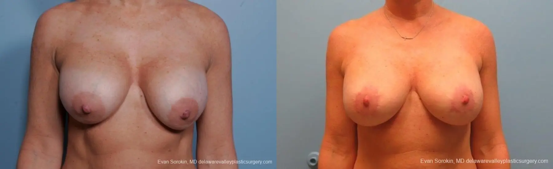 Philadelphia Breast Lift and Augmentation 8690 - Before and After 1