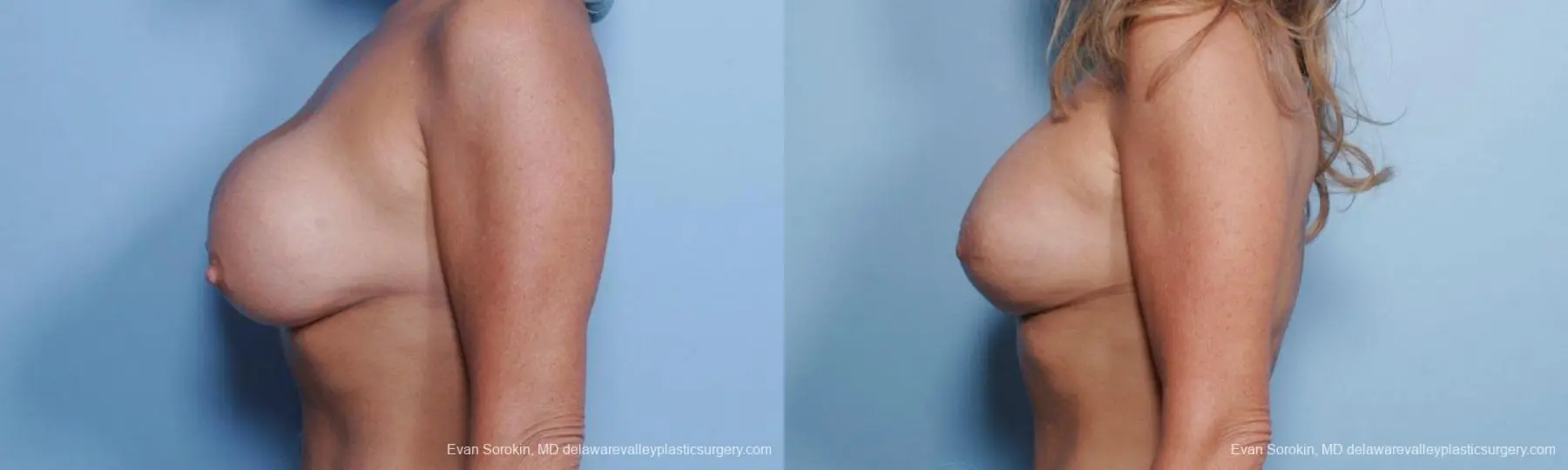 Philadelphia Breast Lift and Augmentation 9453 - Before and After 4