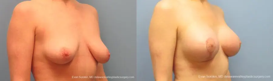 Philadelphia Breast Lift and Augmentation 10116 - Before and After 2