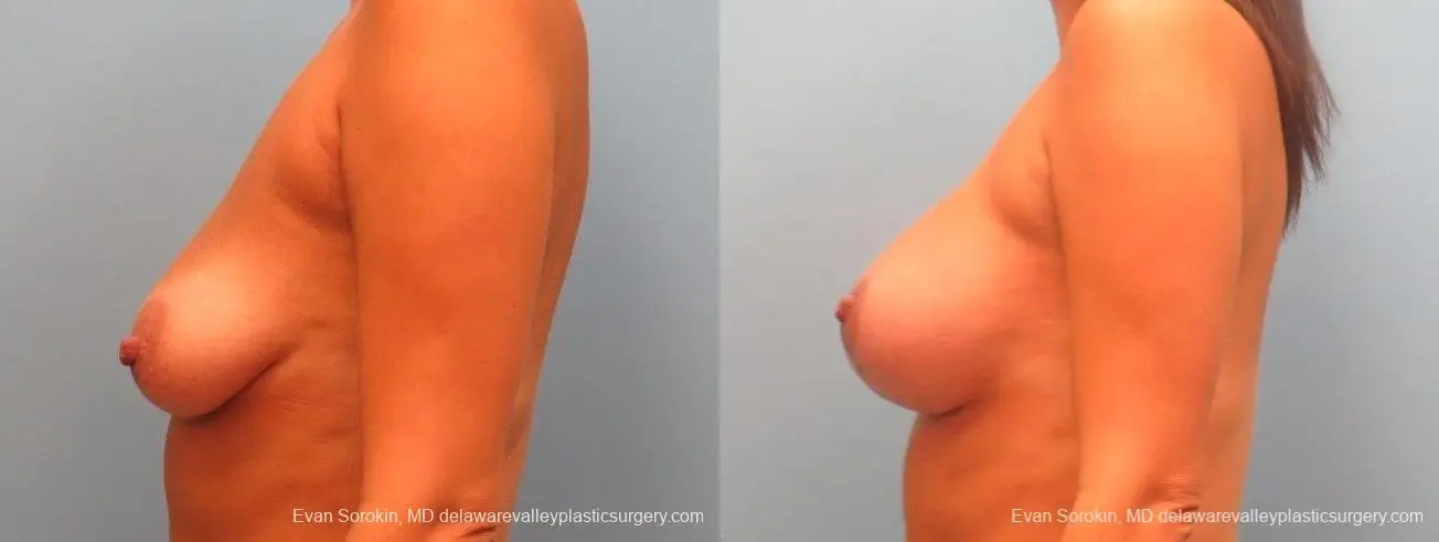 Philadelphia Breast Lift and Augmentation 10247 - Before and After 3