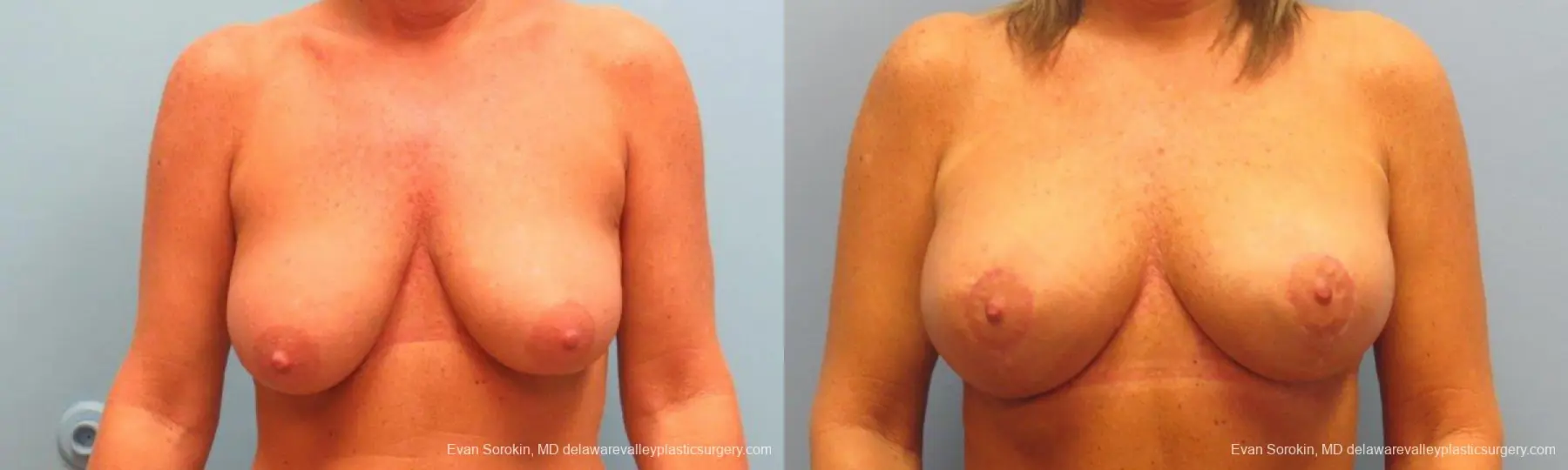 Philadelphia Breast Lift and Augmentation 9398 - Before and After 1