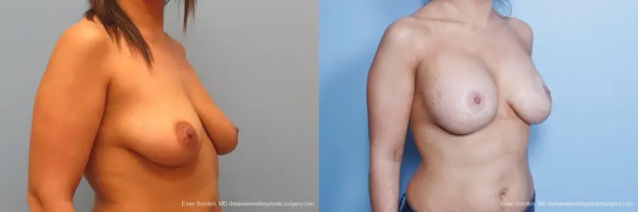 Philadelphia Breast Lift and Augmentation 8688 - Before and After 2