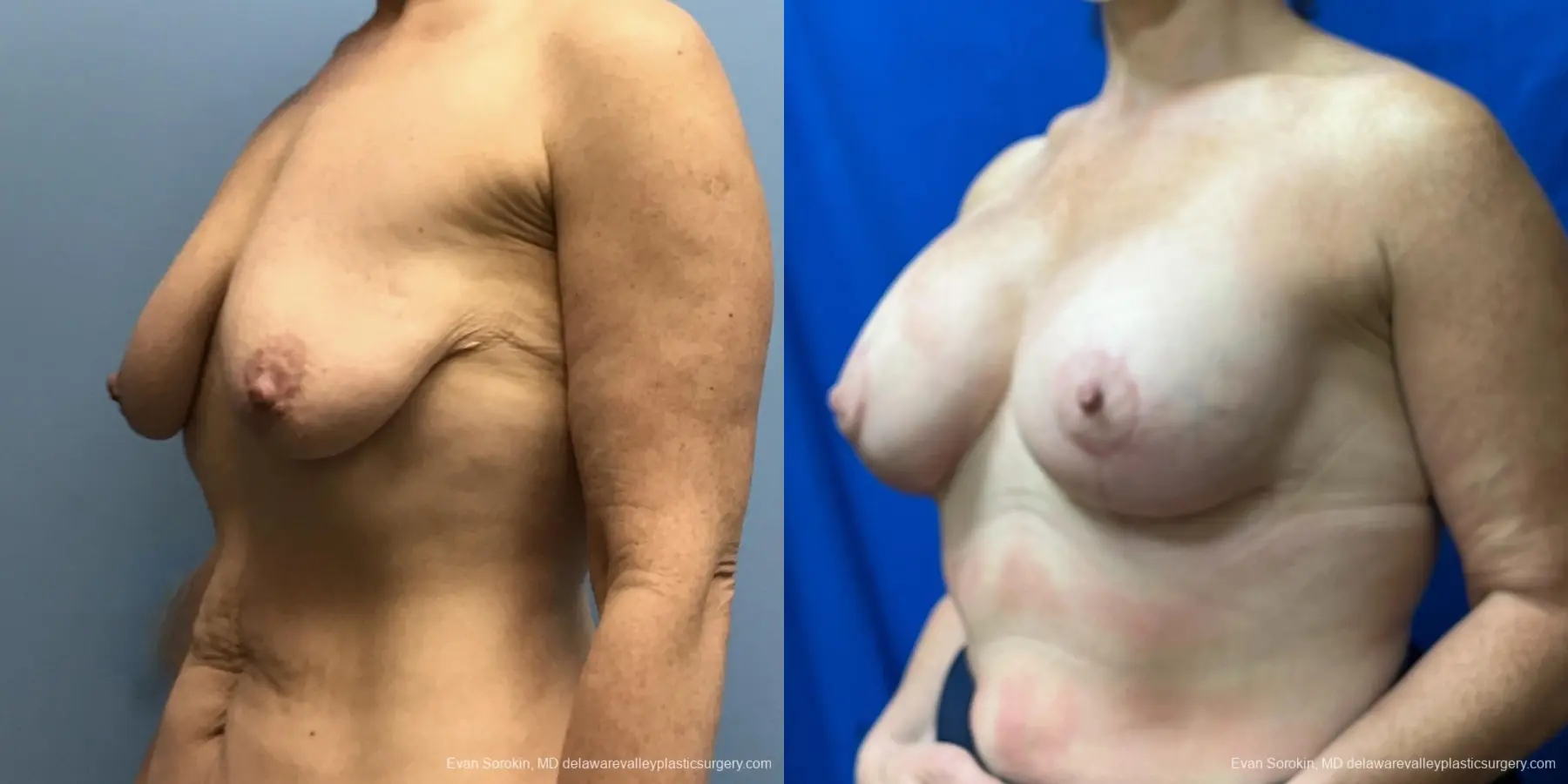 Breast Lift And Augmentation: Patient 47 - Before and After 4