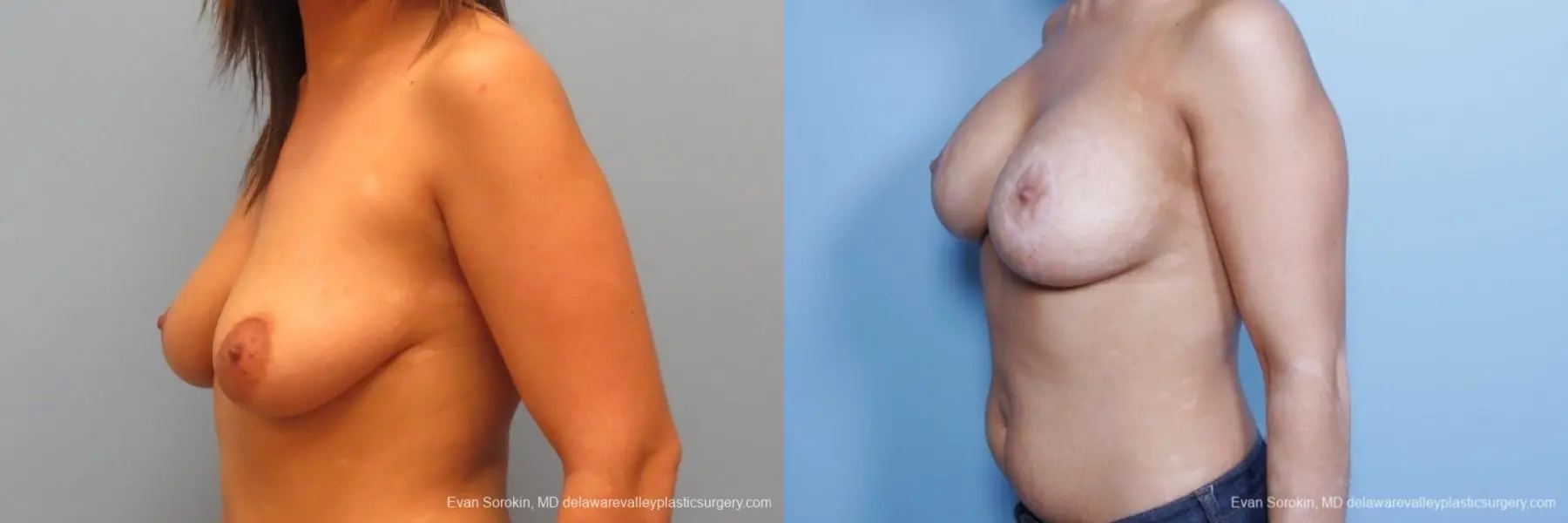 Philadelphia Breast Lift and Augmentation 8688 - Before and After 3