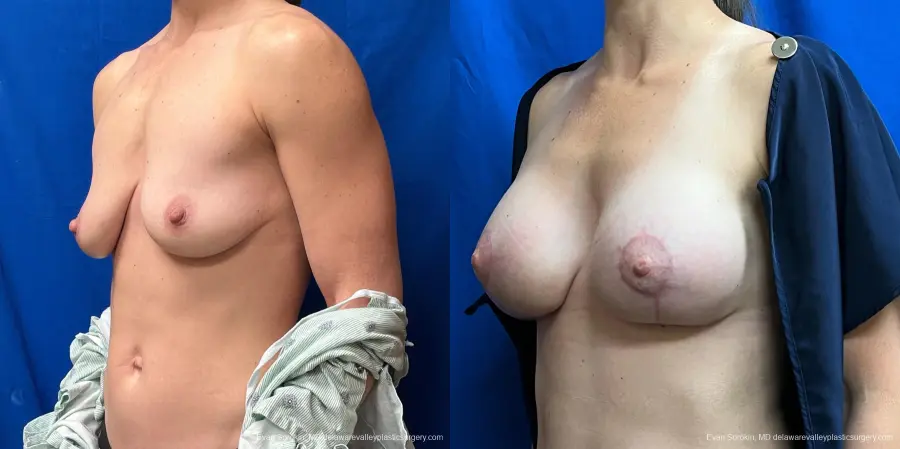Breast Lift And Augmentation: Patient 46 - Before and After 4
