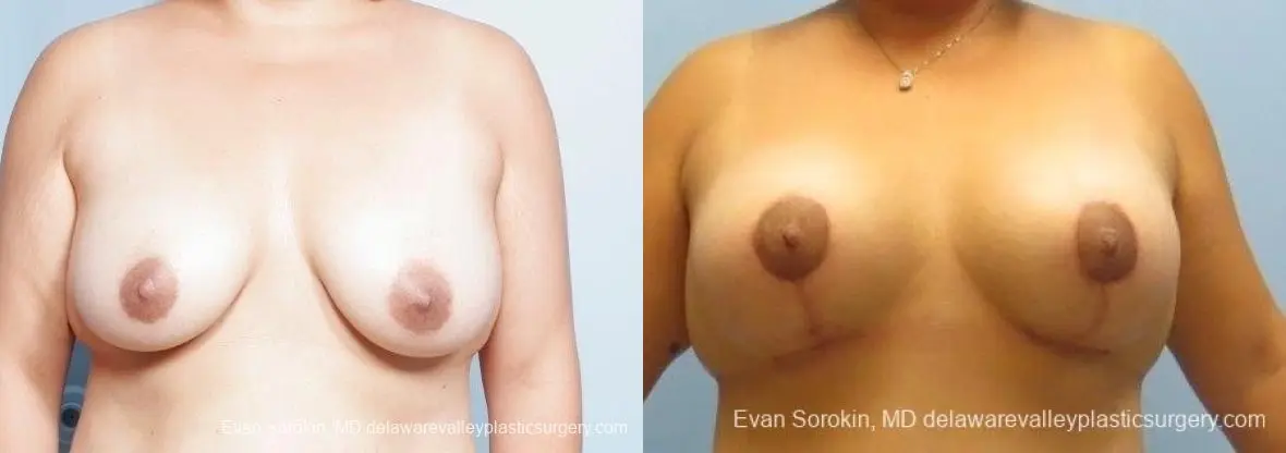 Philadelphia Breast Lift and Augmentation 8677 - Before and After 1