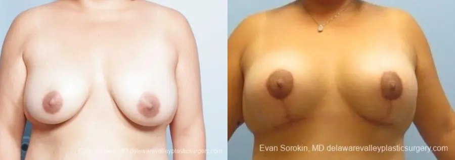Philadelphia Breast Lift and Augmentation 8677 - Before and After 1